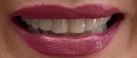 Después del diseño de sonrisa con carillas